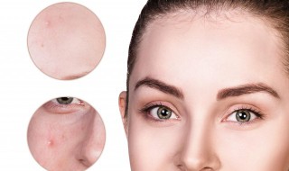 敷什么可以去痘印 敷什么可以去痘印草药