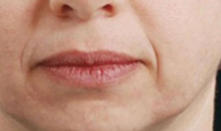 嘴周围有皱纹怎么办（嘴边有皱纹怎么办）