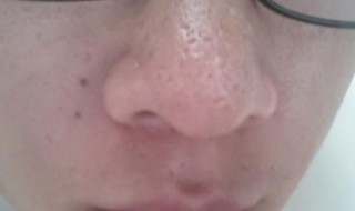 鼻子上毛孔粗大怎么办（脸上和鼻子上毛孔粗大怎么办）