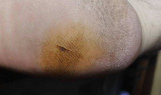 被钉子扎到脚怎么办（被钉子扎到脚怎么办不打破伤风会怎么样）