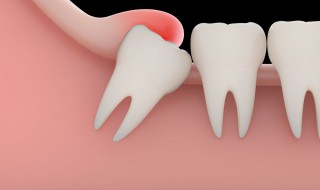 拔完智齿后很疼怎么办（拔完智齿后很疼怎么办咽唾液都疼）