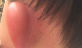 耳朵被蚊子咬了要怎么样（耳朵被蚊子咬了要怎么样处理）