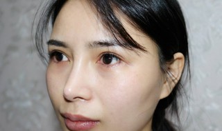 眼袋怎么去掉 遗传的眼袋怎么去掉