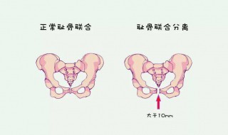 耻骨在哪个位置 人体耻骨在哪个位置
