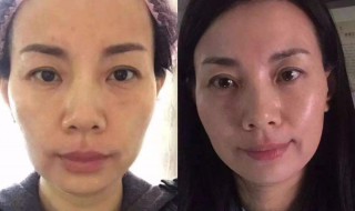 美容除皱方法（美容除皱什么方法最好）