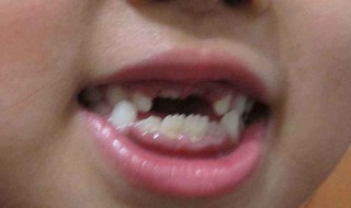 梦见自己掉牙齿 梦见自己掉牙齿掉了很多颗是什么意思 周公解梦