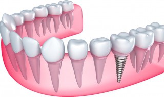 如何清洗假牙（如何清洗假牙的石膏）