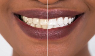 牙齿发黄怎么去除变白（牙齿发黄怎么去除变白小苏打有用吗）