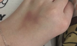 淤血怎么处理（指甲里有淤血怎么处理）