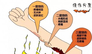 烧伤怎么处理好的快 烧伤怎么办