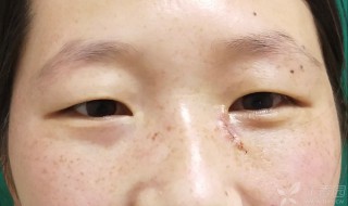 眼角有痣代表什么 男人左眼角有痣代表什么