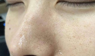 去黑头的小窍门 去黑头小窍门100妙招