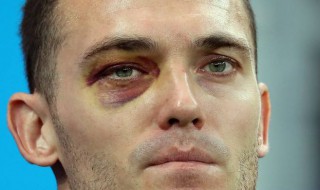 眼睛有黑眼圈怎么办 眼睛黑眼圈怎么办?