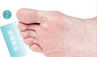 什么是鸡眼 什么是鸡眼,一般都长在哪里