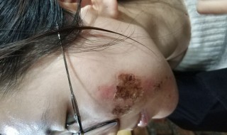 水痘坑的修复方法 水痘留下的坑怎样才能修复