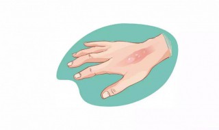 手被油烫伤起泡怎么处理（手被油烫伤起水泡怎么办）