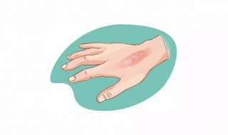 烫伤破皮后怎么处理（烫伤后皮蹭掉后怎么办）