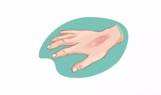 烟头烫伤后怎么处理 被烟头烫伤后怎么办