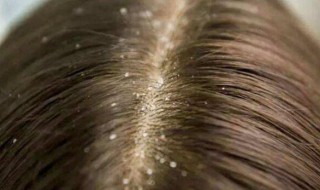 头皮里抠出的东西是什么（头皮里抠出的东西是什么成分）