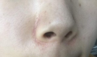 脸上有黑头怎么办 女孩脸上有黑头怎么办