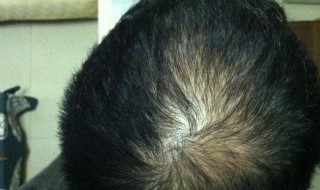 掉头发是因为什么 青少年大量脱发怎么办