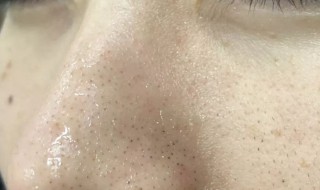 怎样去鼻子黑头 怎样去掉鼻子上的黑头