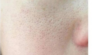 怎样收缩毛孔最有效又简单（毛孔粗大黑头多皮肤油应该怎么办）