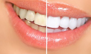 牙齿发黄怎么办 刚换的牙齿发黄怎么办