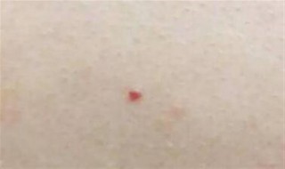 红痣代表什么（红痣代表什么寓意）