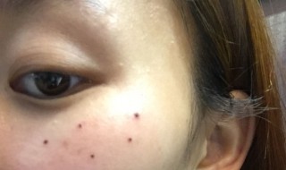 脸上的痣哪些不能点掉 女人10处有痣是富贵痣