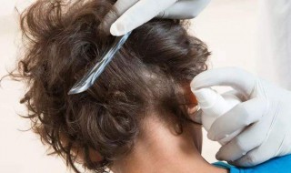 头上长虱子怎么办怎样消除（阴虱子最怕3个克星）