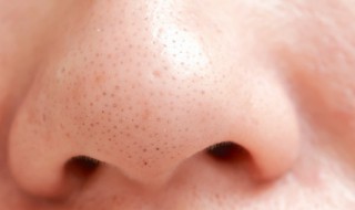 黑头是怎样产生的 黑头不挤会自己消失吗