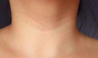 颈纹怎么消除简单方法 去除颈纹最快最有效的方法