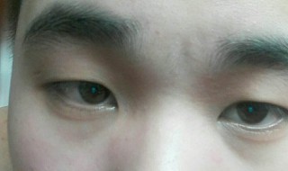 5分钟去黑眼圈小方法（眼圈发黑警惕四种病）