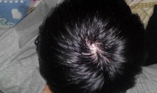 脱发了如何能让头发再生（脱发了如何能让头发再生长）