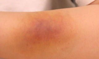 鸡蛋敷淤青正确做法 鸡蛋敷淤青正确做法视频