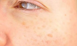 消除眼袋好方法（消除眼袋好方法视频）