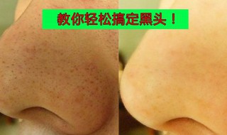 清理黑头最有效的方法（清理黑头最有效的方法视频）