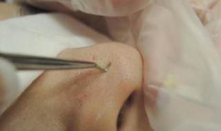 去黑头粉刺方法（去黑头粉刺方法视频）