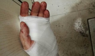 手指被刀割伤怎么处理