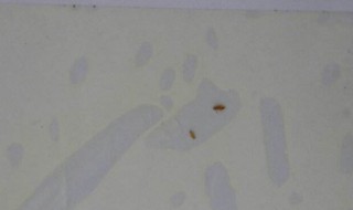 尘虱最简单的去除方法（螨虫和阴虱的区别图片）