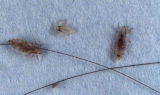 怎样快速除掉虱子 怎样快速除掉虱子视频