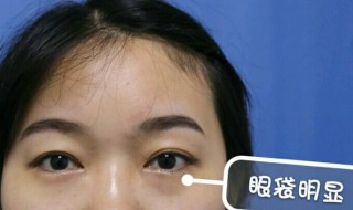 有什么祛眼袋的好方法 简单有效的祛眼袋方法