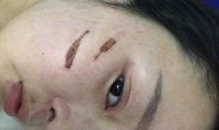 去疤去印的方法（去疤去印的方法图片）