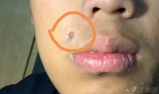 脸上哪些痣不能去掉 脸上哪些痣不能去掉示意图女