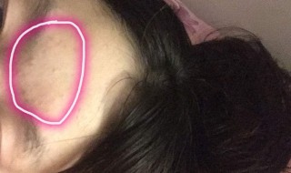 眉心重复长痘怎么处理 眉心重复长痘怎么处理最好